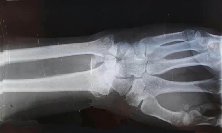 Inovativní 3D-tisk implantátu kotníku od Strykeru